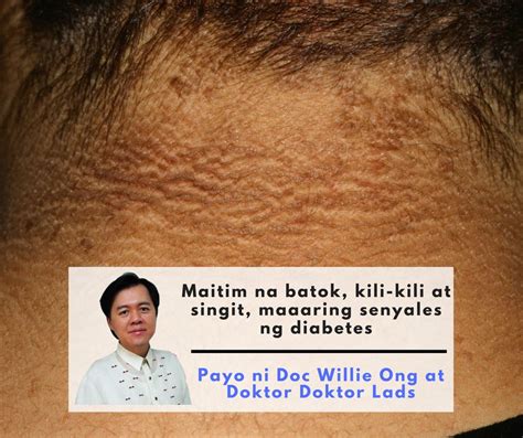 Maitim na leeg at batok .
